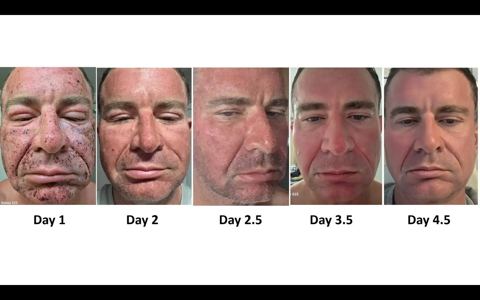 Real patient recovery from day 1 to day 4.5 after aggressive CO2 laser resurfacing