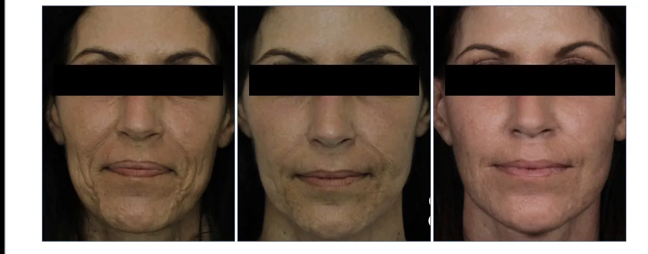 Three-stage facial rejuvenation results