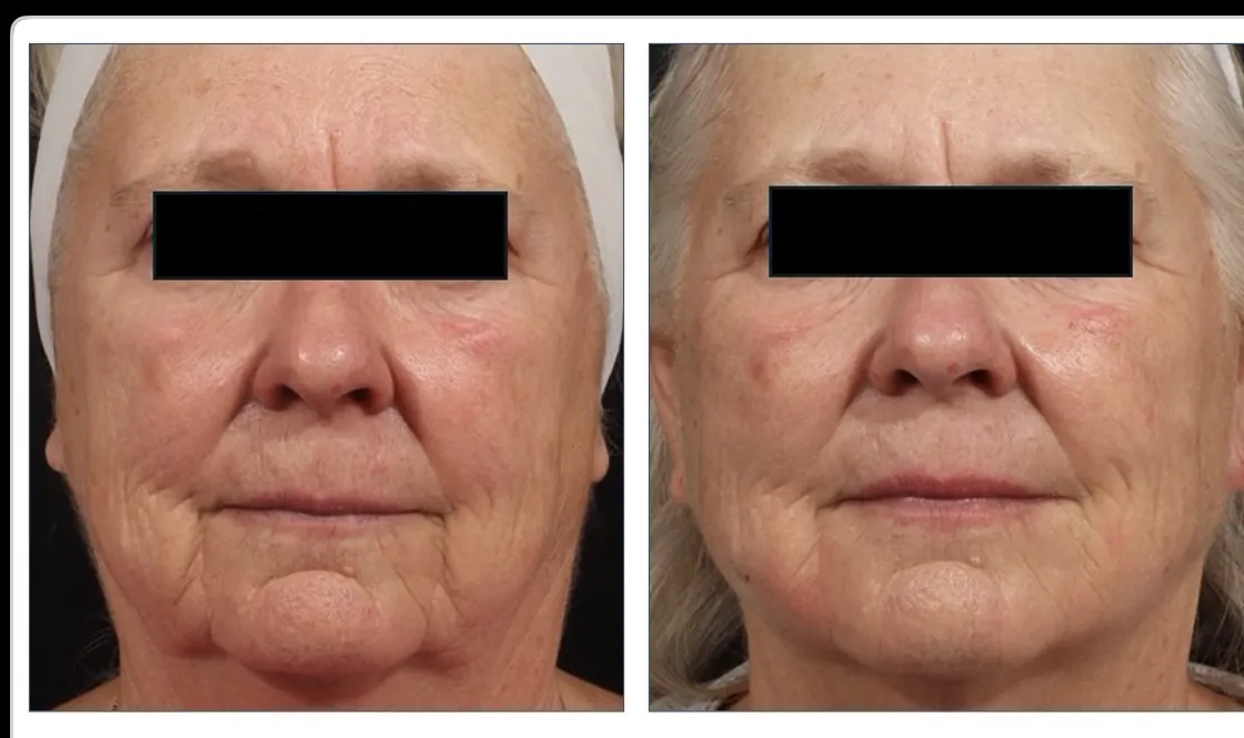 Before and after combination treatment