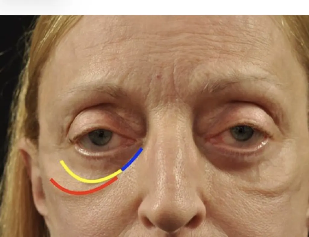Midface ligament anatomy showing orbicularis retaining ligament (yellow), maxillary attachment (blue), and zygomaticocutaneous ligament (red)