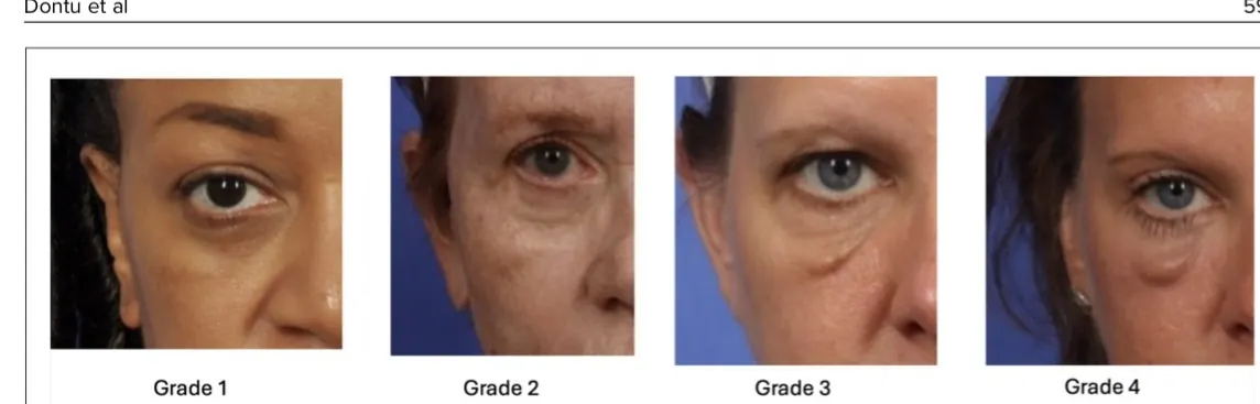 Festoon grading scale from Grade 1 (mild delineation) to Grade 4 (severe protrusion)