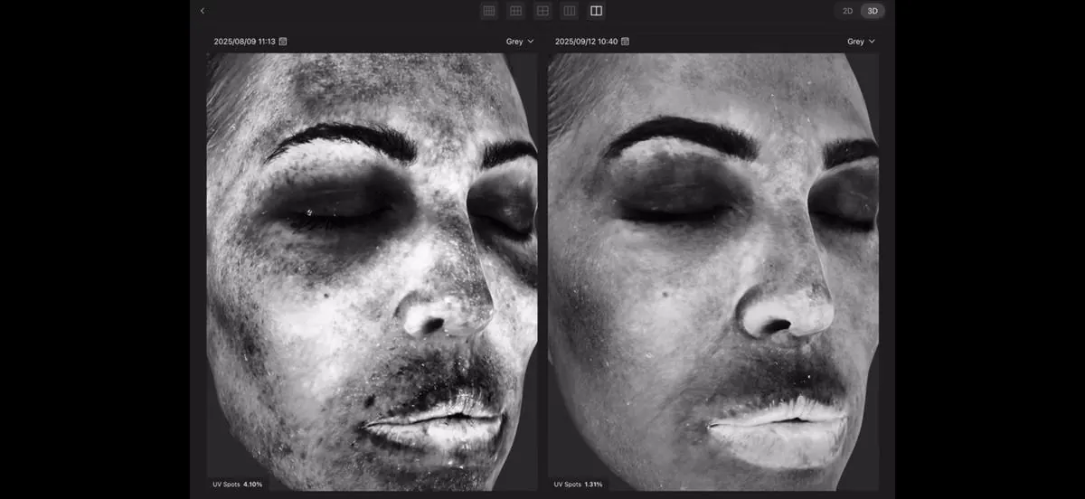 UV Spots analysis, female patient: 4.10% to 1.3%