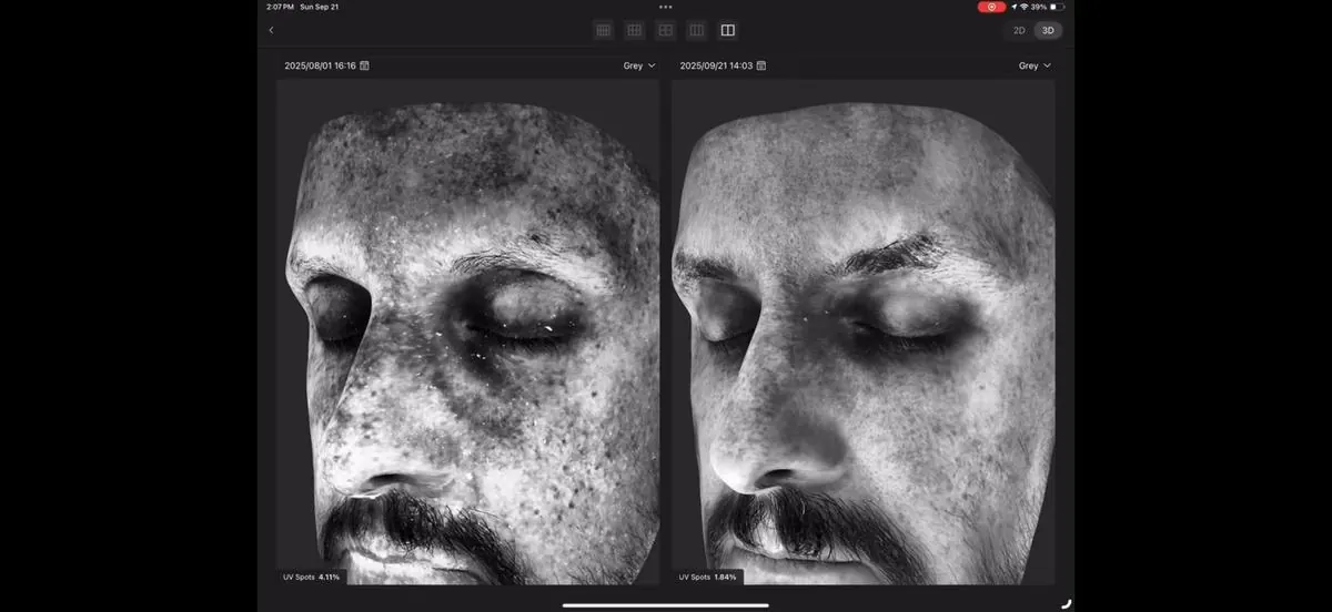 UV Spots analysis, male patient: 4.11% to 1.84%