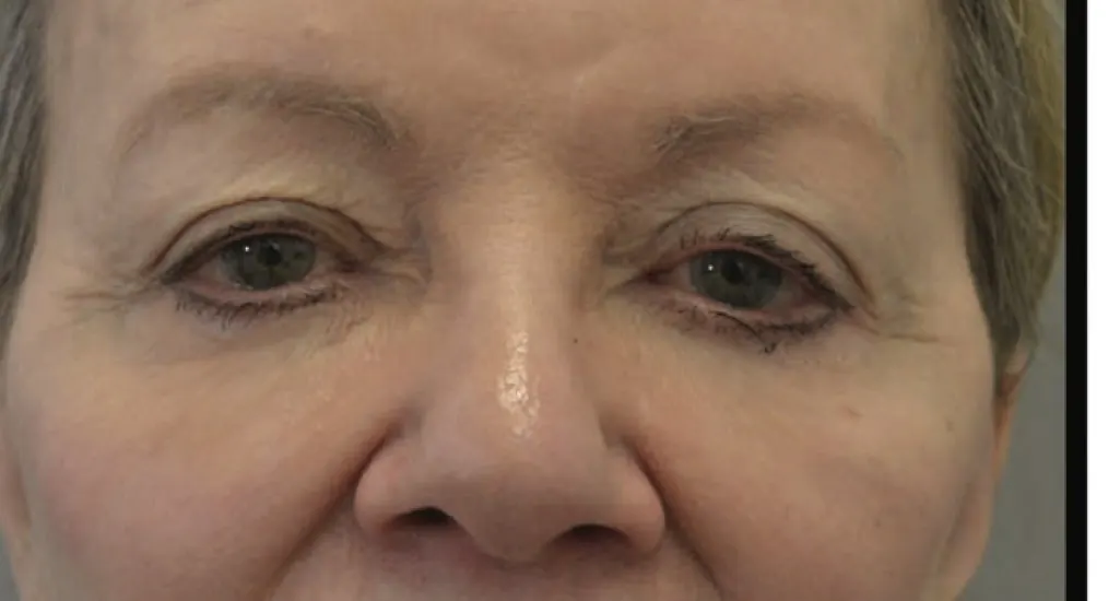 Malar edema post-treatment showing reduced puffiness