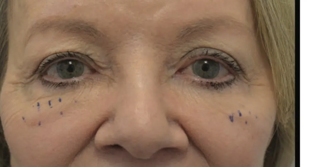 Malar edema with injection markings showing treatment planning precision