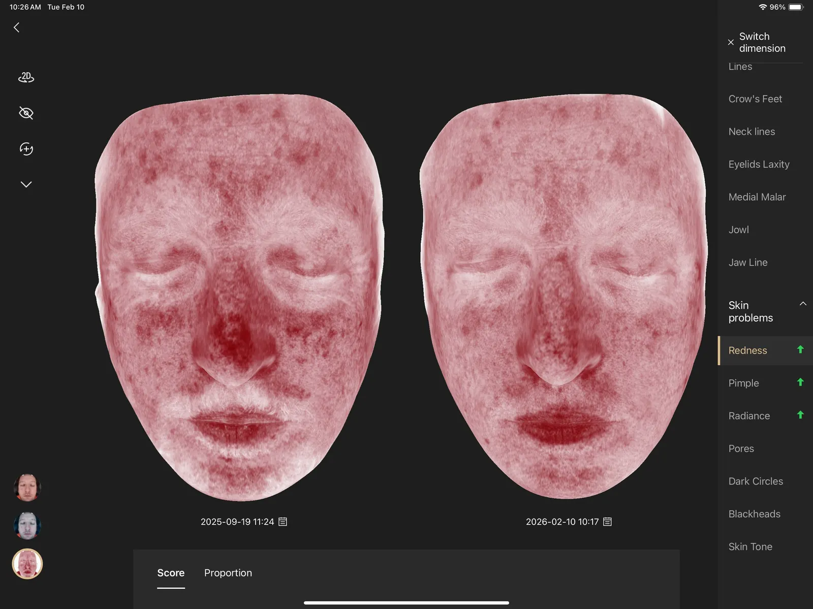 VISIA redness analysis