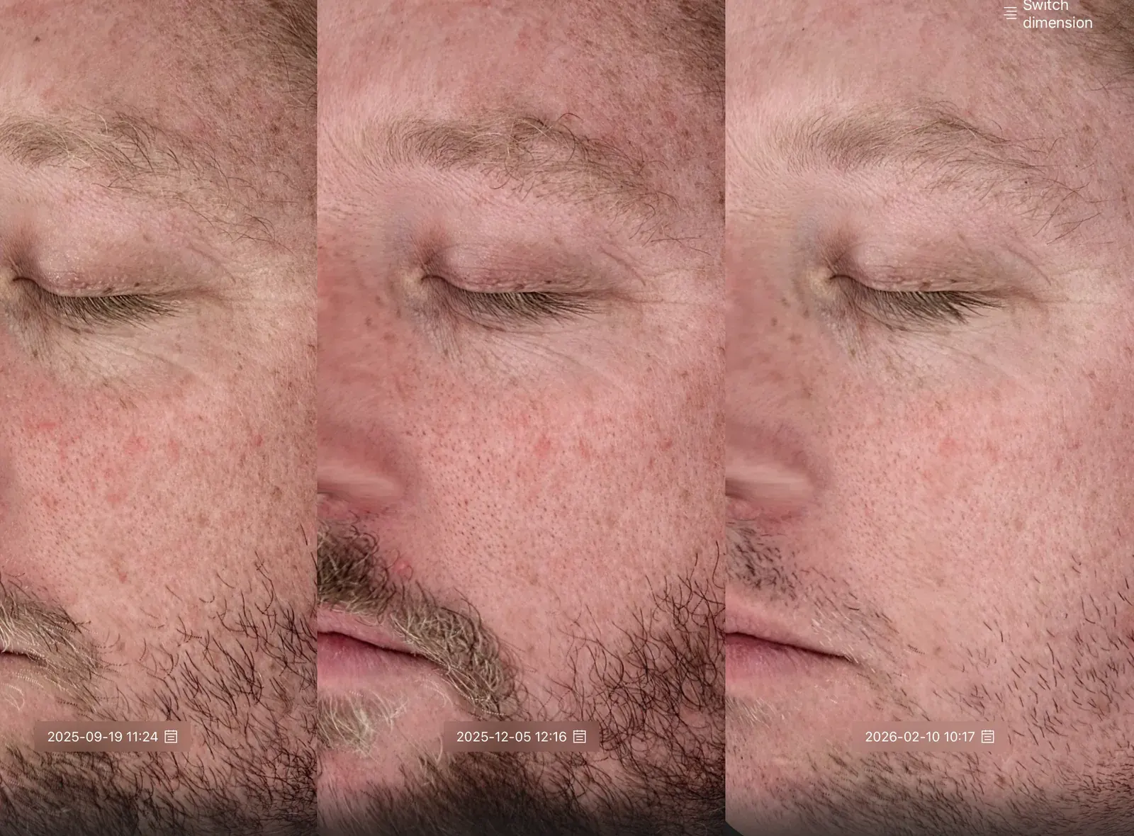 Three-visit progression of a patient's cheek and under-eye on the formulation